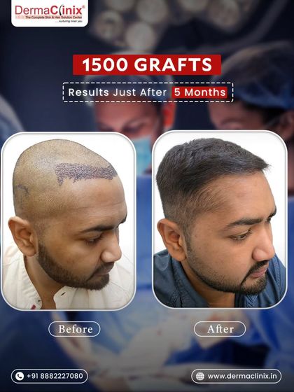A stunning transformation just five months after a 1500 graft transplant. While full results take 9 to 12 months, our customized treatment plans often lead to faster visible growth and a natural hairline design.