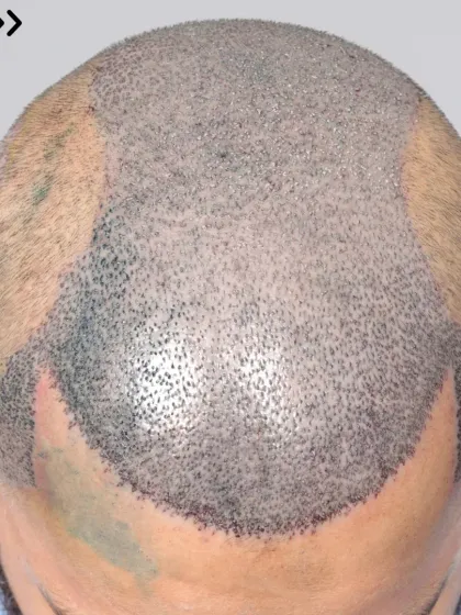 For this Norwood Grade 6 patient, we used 5500 grafts to provide complete coverage, recreating the hairline, frontal part, mid-scalp, crown, and temples.