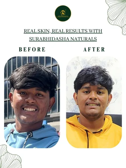 This is why I do what I do. Seeing real transformations like this client's journey from dealing with acne to enjoying clear, healthy skin is my greatest reward. It’s proof that gentle, natural ingredients can truly heal.