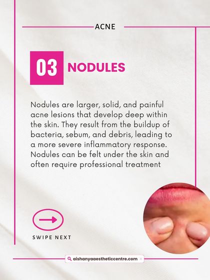 Nodules are a more severe form of acne, appearing as large, solid, painful lumps deep within the skin. These require professional dermatological treatment to prevent scarring and reduce inflammation.