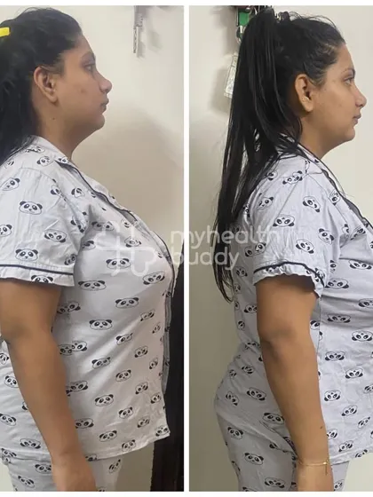 Vidhi's side profile comparison, showing a visible improvement in her posture and body composition.