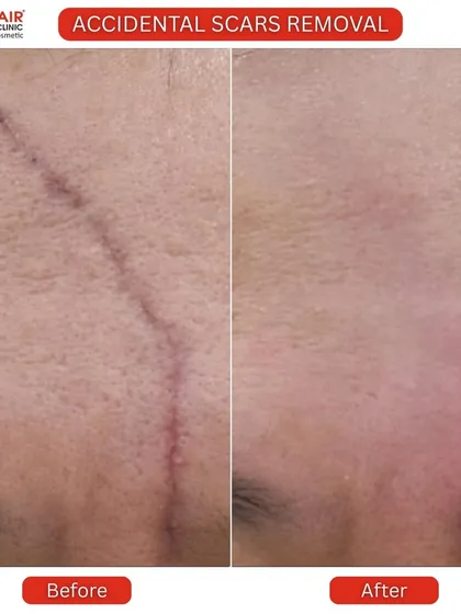 Scars can come from anywhere, not just acne. Here you can see the remarkable reduction of a prominent accidental scar on the forehead. Our treatments work to break down old scar tissue and encourage the growth of new, smoother skin, making past injuries much less visible.