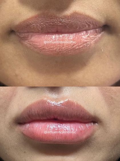 A before and after demonstrating how we can enhance pigmented lips, giving them a healthier, plumper, and more uniform appearance.