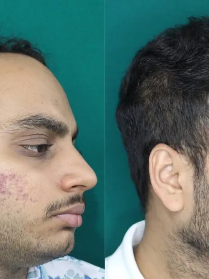 Another angle highlighting the restored hairline and its natural flow. My goal is always to create hair that you can style and live with, without anyone knowing you've had a procedure.