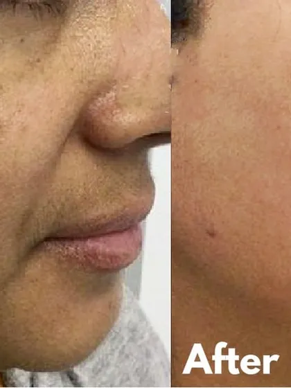 This image shows a real patient's journey in treating melasma, a challenging form of hyperpigmentation. Through a customized plan involving laser toning and medical-grade skincare, we were able to significantly lighten the dark patches and restore a more even skin tone.