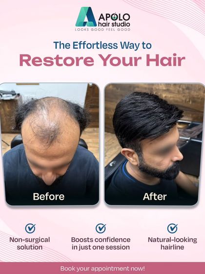 This transformation highlights the confidence boost that comes with a restored hairline. Our non-surgical solution provided this client with a natural-looking result in just one session, effortlessly covering the balding area.