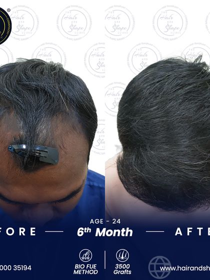 This top-down perspective at 6 months shows how effectively the BIO FUE technique addresses thinning on the scalp.
