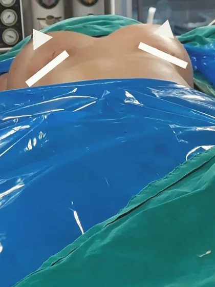 This image shows the immediate result after breast augmentation surgery. The white markers indicate the improved contour and volume. This procedure is designed to enhance the patient's natural figure and boost self-confidence.