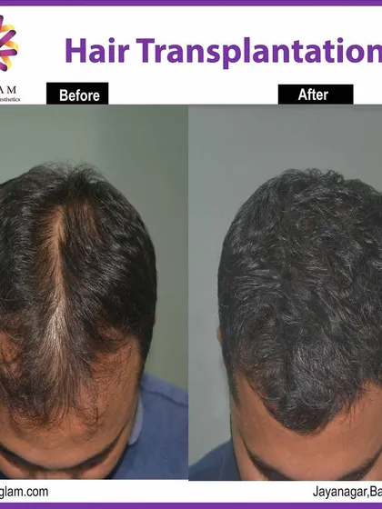 A top-down view showcasing the remarkable results of our hair transplant procedure. We successfully filled in the thinning crown area, achieving a full and youthful appearance.