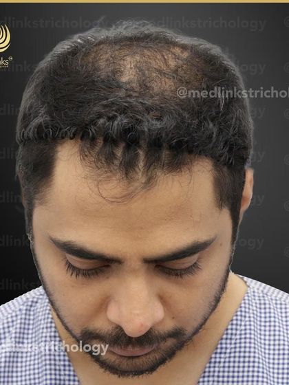 A top-down view of the patient's hair loss before the transplant.