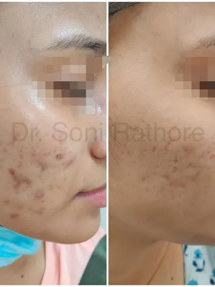Here is another example of getting active acne under control. By calming the inflammation and preventing new pimples, we create a clear canvas to work on for any residual scarring or pigmentation.