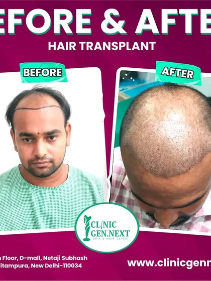 This image shows the patient's pre-op state and the immediate post-op result, highlighting the area we covered with the transplant.