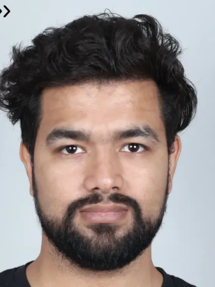 A 10-month natural transformation for a Grade 3 baldness case using 3700 grafts. We recreated the hairline, temples, and frontal zone.