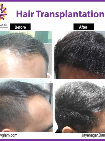 This client regained a fuller, more youthful hairline with our hair transplantation service. The 'after' photos show increased density and a well-defined hairline from both top and side angles.