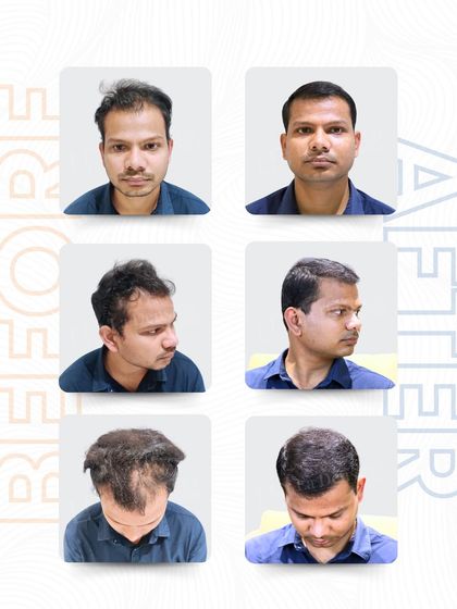A complete view of Mr. Suryakant’s transformation. These before-and-after images from all angles show the comprehensive restoration of his hairline and crown, resulting in a balanced, dense, and natural appearance.