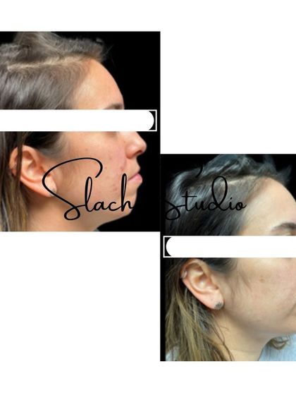 This side profile collage shows a clear reduction in acne scarring and an overall improvement in skin smoothness.