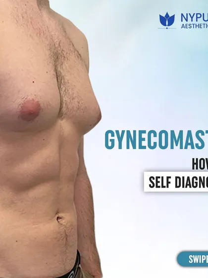 This guide explains how to self-diagnose gynecomastia. Understanding the symptoms is the first step toward finding the right solution for a more masculine chest contour.