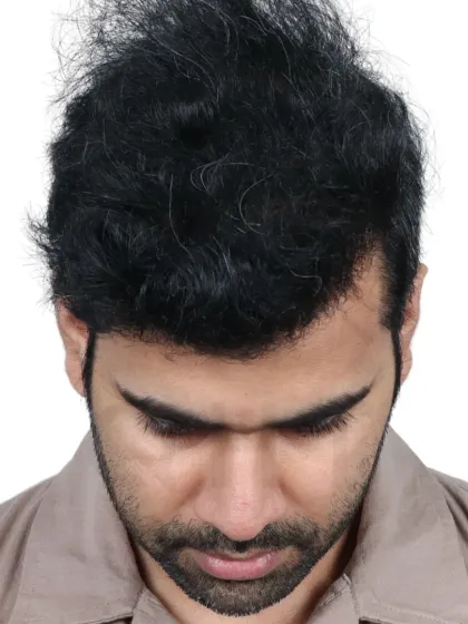 A 14-month transformation for a Diffuse Grade 5A case. We used 4200 grafts to recreate the hairline and re-densify the frontal and mid-scalp.