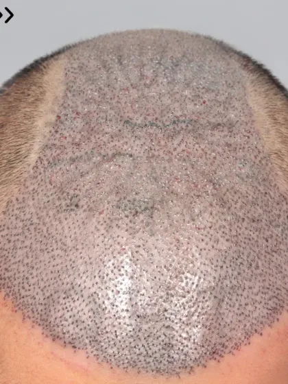 Immediate post-surgery view of a Norwood Grade 5A transformation. 5000 grafts were used to recreate the hairline and restore the frontal and mid-scalp regions.