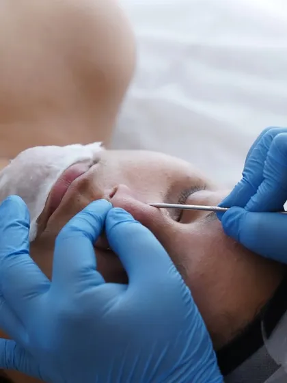 Gentle and precise extraction is an important step for clearing congested pores. I perform this carefully after steaming the skin to ensure minimal discomfort and clear results.
