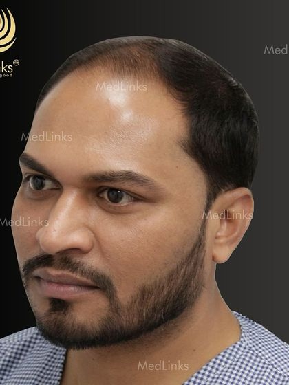 The patient's hair from the side before the procedure.