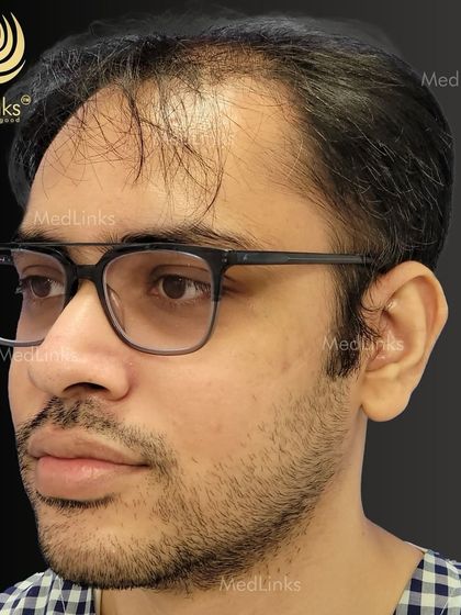 The patient's hair from the side before the procedure.