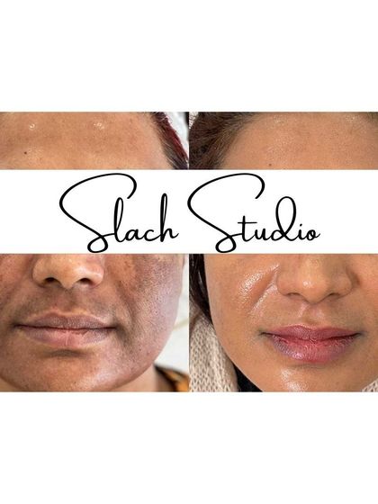 This before-and-after shows a dramatic lightening of pigmentation and a more vibrant, healthy-looking complexion.