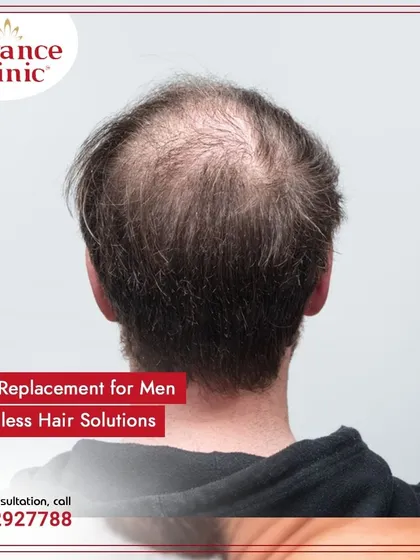For men experiencing thinning on the crown, a hair replacement system offers a seamless fix. There are no scars or side effects, just a full head of hair.