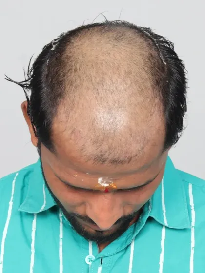 A 9-month transformation for a Diffuse Grade 5A patient. We used 4800 grafts to achieve dense, even coverage and a natural hairline.
