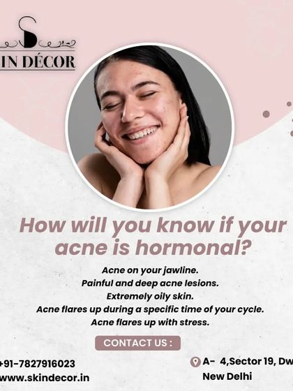 How can you tell if your acne is hormonal? Look for patterns like breakouts on your jawline, painful and deep lesions, and flare-ups that coincide with your menstrual cycle or periods of high stress. Recognizing these signs helps in creating a more targeted treatment plan.