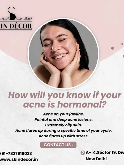 How can you tell if your acne is hormonal? Look for patterns like breakouts on your jawline, painful and deep lesions, and flare-ups that coincide with your menstrual cycle or periods of high stress. Recognizing these signs helps in creating a more targeted treatment plan.