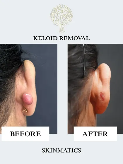 This before and after shows the result of a keloid removal from an ear piercing. This is a common issue, and we use precise surgical excision techniques to safely remove the overgrown scar tissue and carefully restore the natural shape of the ear with the best possible cosmetic outcome.