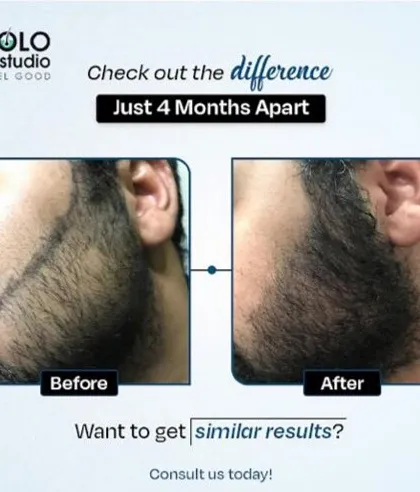 Results take time, and we believe in showing the real journey. These photos, taken just four months apart, document how a client's beard filled in after our FUE procedure, covering a scar and creating a seamless, dense look.