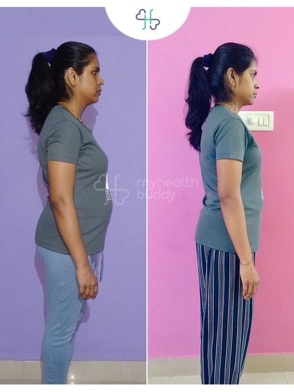 This client learned about Diastasis Recti after her pregnancy and decided to take action. In 12 weeks, she lost 6 kgs and significantly improved her core strength by focusing on portion control and targeted exercises.