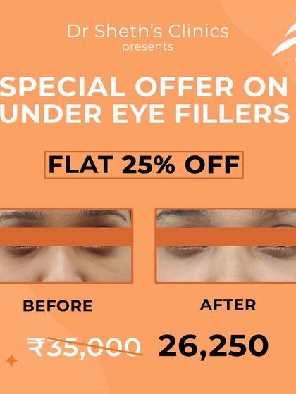 Under-eye fillers can dramatically reduce the appearance of dark circles and hollowness. This before and after image shows how we restore volume to the tear trough area, creating a brighter, more rested, and rejuvenated look.