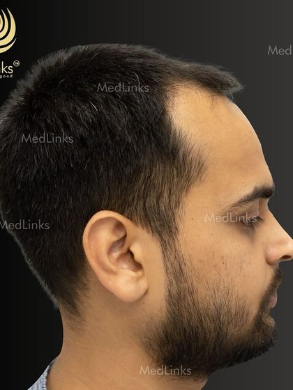 The patient's hair from the side before the procedure.