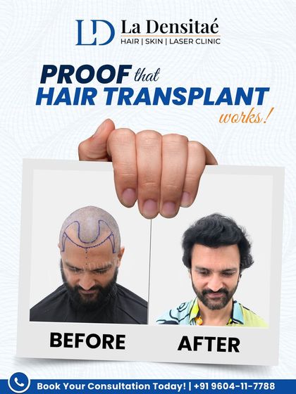 When a voice actor you've heard a thousand times trusts my clinic, it says something. Rajesh Kava’s journey is proof that my advanced hair transplant delivers results that look 100% natural.