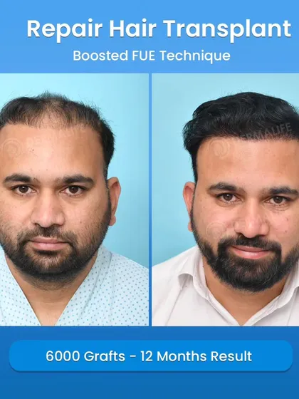 A significant part of my practice involves correcting previously failed transplants. This before-and-after image shows a 12-month result of a repair case where I used 6000 grafts to fix a botched job and create a dense, natural-looking outcome.