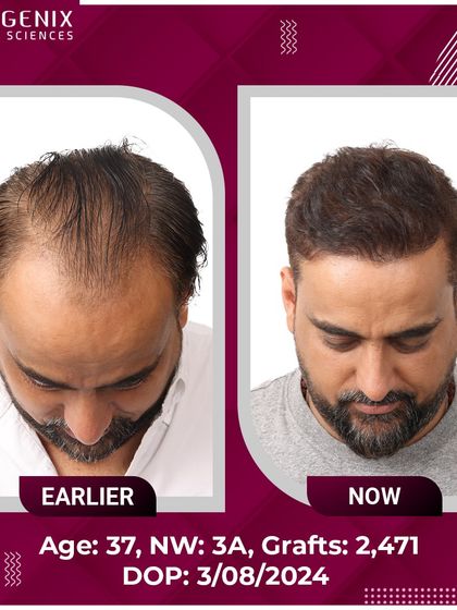 The confident smile of this 37-year-old after his 2471-graft procedure says it all.