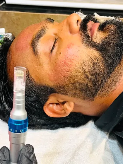 This image shows a microneedling treatment for open pores. This procedure stimulates collagen production, which helps to tighten the skin and reduce the appearance of enlarged pores over time.