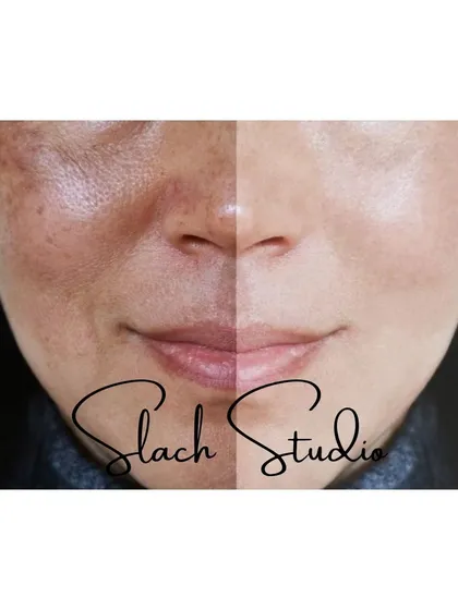This split-face image provides a direct comparison, highlighting the dramatic difference in skin tone and texture.