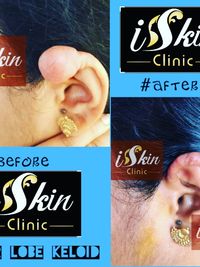 Dermatological Surgery