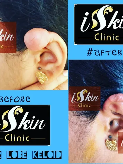 This before and after image displays the successful surgical removal of a large earlobe keloid. We carefully excised the overgrown scar tissue and reconstructed the earlobe to restore its natural shape, a common procedure we perform for patients post ear piercing.