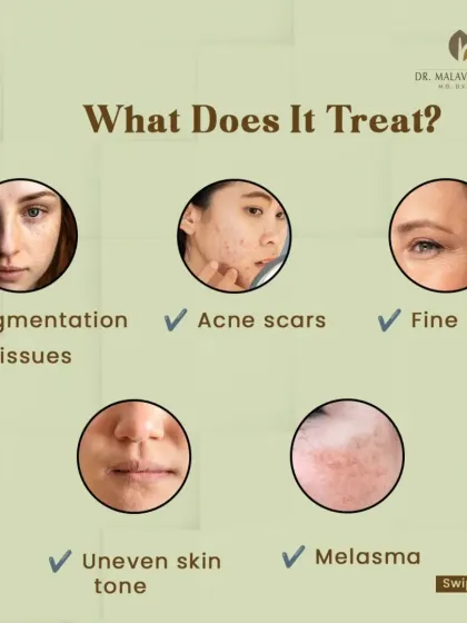 Laser toning is a versatile treatment indicated for a range of concerns. It effectively addresses pigmentation issues, acne scars, fine lines, uneven skin tone, and melasma, making it a valuable tool in my practice.