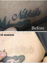 Laser Tattoo Removal
