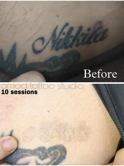 This before-and-after image shows the significant fading of a name tattoo after 10 sessions. My goal is to give you a clean slate, and this demonstrates the real, visible results of my professional laser removal process.