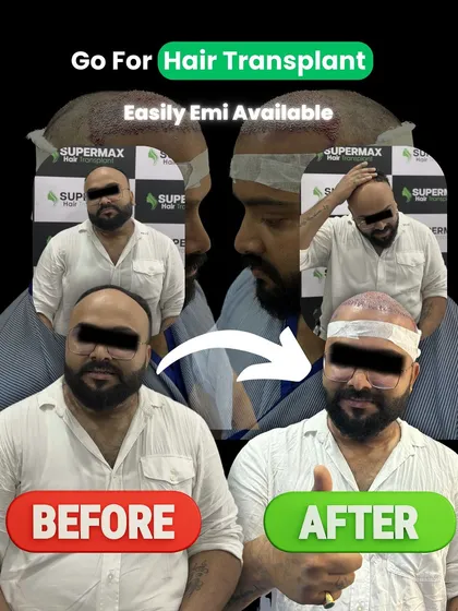 Go for a hair transplant. This collage shows the clear difference it can make, with easy EMI options available.