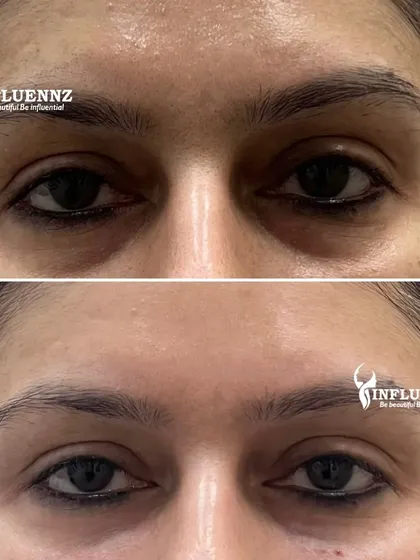 A stunning before and after of an under-eye filler treatment. By carefully placing filler in the tear trough area, we can erase dark circles and hollows for a brighter, more rested appearance.