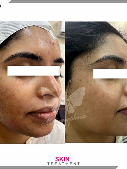 This client's skin treatment journey shows a visible reduction in both acne and pigmentation, leading to a clearer complexion.