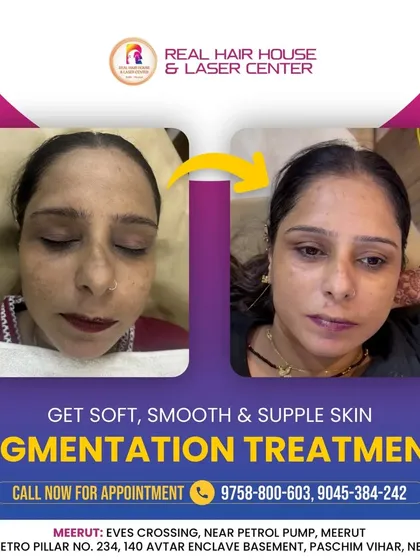 A picture is worth a thousand words. This before-and-after shot clearly shows the significant reduction in pigmentation and dark spots. My goal is to give you soft, smooth, and supple skin that you feel great in.